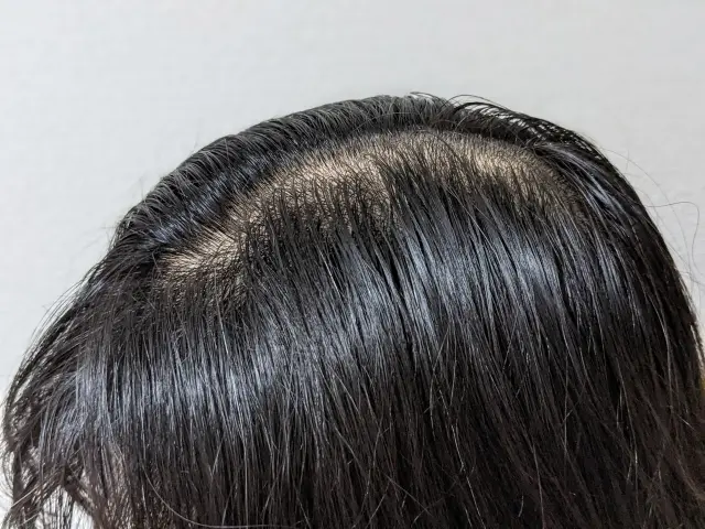 頭頂部の薄毛が進行し、ピンク色の地肌が黒髪に囲まれてはっきりと目立っている男性の頭部。男性型脱毛症(AGA)特有の頭頂部脱毛の進行例を示すイメージ。