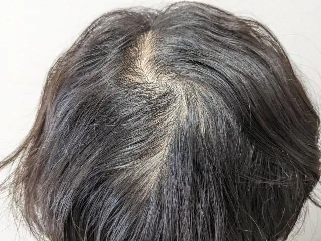 頭髪全体にわたり明らかに薄毛が進行し、頭皮が透けて見える状態の頭部。脱毛症による毛髪量の減少が一目で分かる様子。
