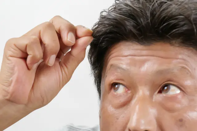 自然な植毛ならFUT法！仕上がりがバレない理由とは｜ヒロクリニック