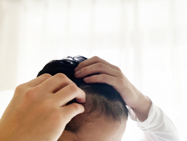 頭皮に手を当てながら、ヘアトランスプラントのドナー部位選定に悩む男性。ドナー毛採取によって新たな悩みが生まれないかを真剣に考える様子