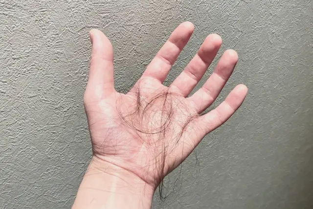手のひらに抜け落ちた髪の毛が乗っている男性のイメージ。脱毛や抜け毛の悩み、毛髪サイクルによる自然な髪の減少を象徴するストック写真。