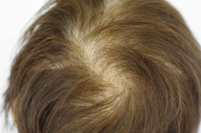 上空から見た頭皮のクローズアップ画像。部分的に毛量が減少しており、薄毛やびまん性脱毛の兆候が見られるスカルプコンディションの参考イメージ