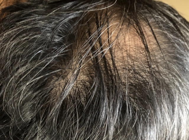 髪がまばらになった頭皮のクローズアップ画像。進行する薄毛の状態を示し、自毛植毛や再生医療の必要性を訴えるビジュアル。