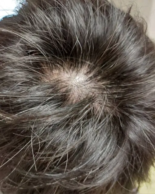 頭頂部(クラウン)に集中的な薄毛が見られる男性の頭皮の上面図|脱毛部位縮小術の対象となる典型的な脱毛パターン