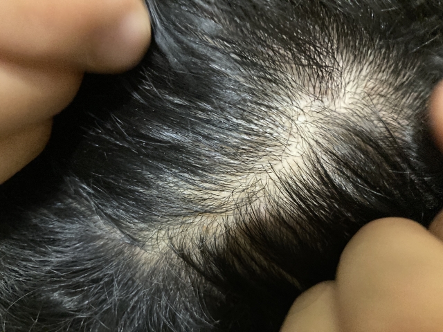 頭頂部の地肌が透けて見える薄毛の男性頭皮の様子。軽度〜中等度の男性型脱毛症(AGA)の進行例として、頭皮フラップ手術の適応外である可能性があるケースのイメージ。