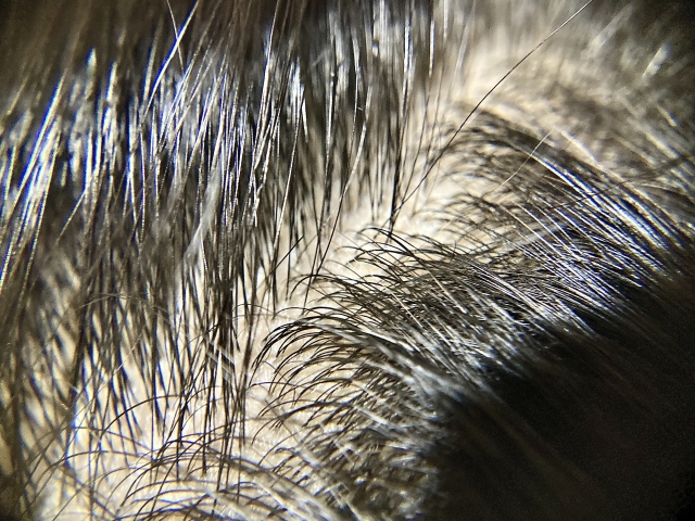 長く伸びた髪の下に地肌が透ける薄毛の頭皮。毛髪の密度が低く、ベージュ色の頭皮が黒髪の合間から目立って見えるFUE対象者の典型例