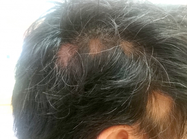 側頭部から後頭部にかけて目立つ複数の脱毛箇所が確認できる男性の頭部写真（男性型脱毛症の進行例）