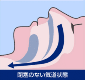 正常な気道の状態を示した図
