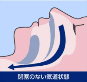 正常な気道の状態を示した図