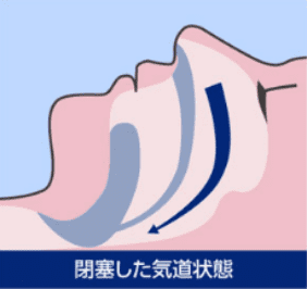 舌根沈下により気道が塞がった状態を示した図