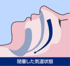 舌根沈下により気道が塞がった状態を示した図