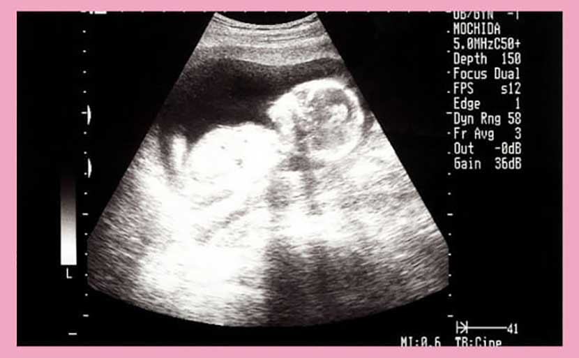 妊娠15週目のエコー画像