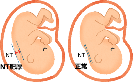 NT肥厚