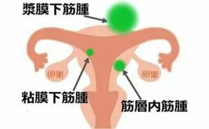 子宮筋腫とはどんな病気？知っておくべき子宮筋腫のこと　子宮筋腫　イラスト