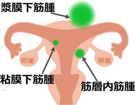 子宮筋腫の種類