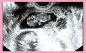 妊娠10週目で起こる母体の変化と赤ちゃんのエコーでわかるダウン症【医師監修】（エコー写真の画像あり）