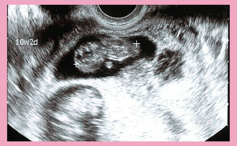 エコー写真 妊娠初期