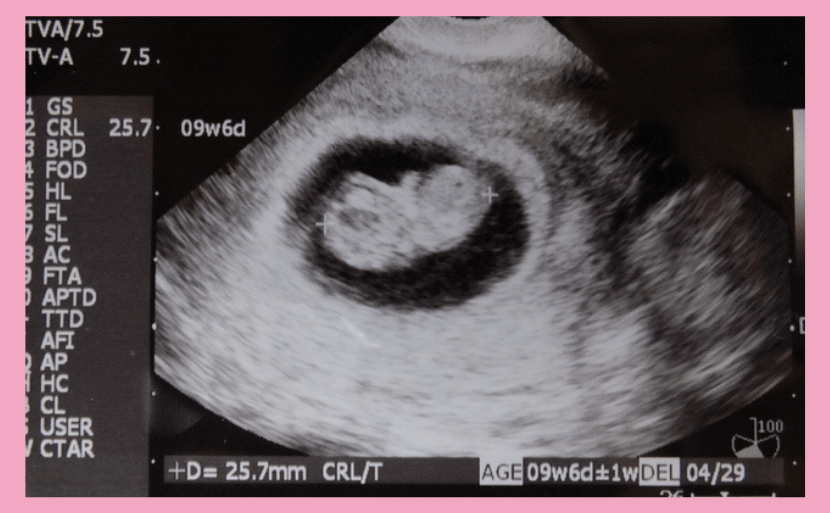 妊娠9週目の母体変化とエコーでわかるダウン症【医師監修】(エコー写真