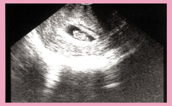 妊娠7週目のダウン症赤ちゃんのエコー写真
