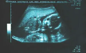 21トリソミー（ダウン症候群）はいつ分かる?　エコー写真