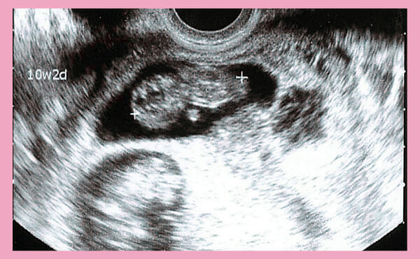妊娠10週目で起こる母体の変化と赤ちゃんのエコーでわかるダウン症 医師監修 エコー写真の画像あり ヒロクリニック