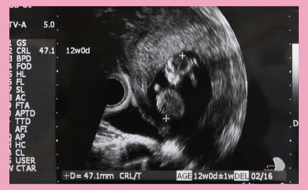 妊娠12週目のダウン症赤ちゃんのエコー写真