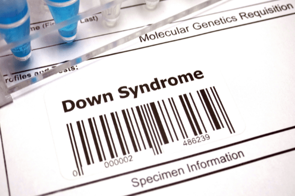 signs-of-down-syndrome 21トリソミー(ダウン症)は妊娠中に予兆はある?