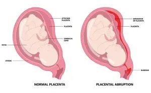 常位胎盤早期剝離とは