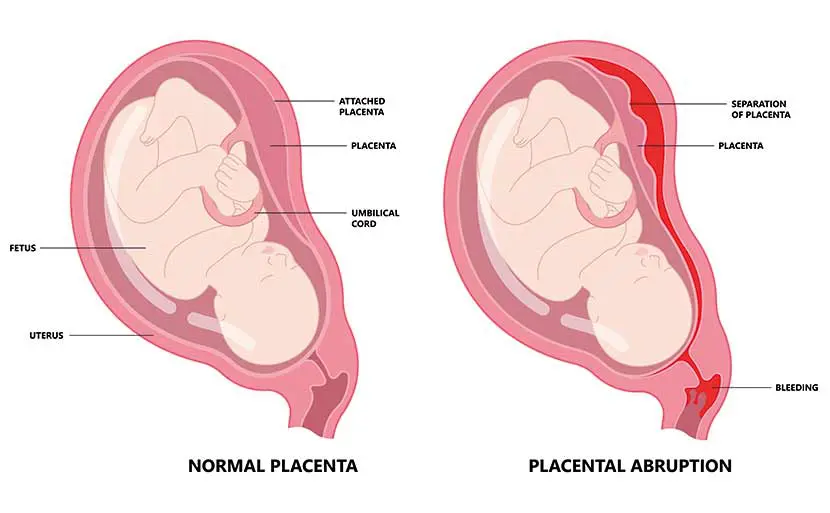 常位胎盤早期剝離とは