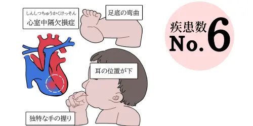 エドワーズ症候群