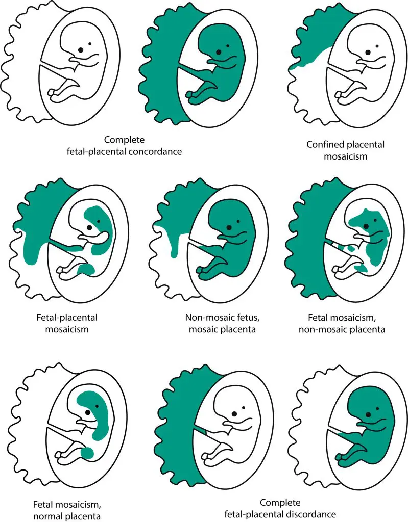 Pitfalls of prenatal diagnosis associated with mosaicism