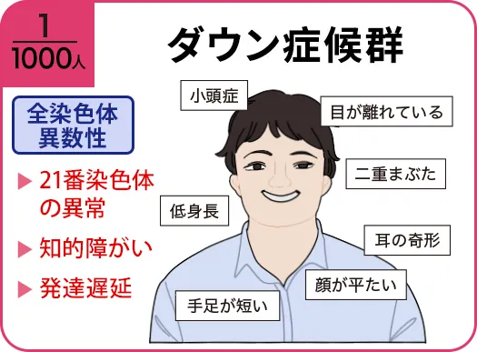 ダウン症