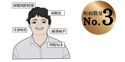 唐氏综合征