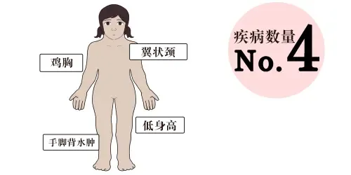 特纳综合征