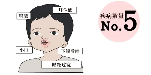 迪乔治综合征
