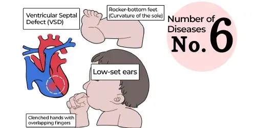 Edwards Syndrome