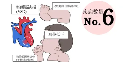 爱德华氏综合征