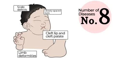 Patau Syndrome