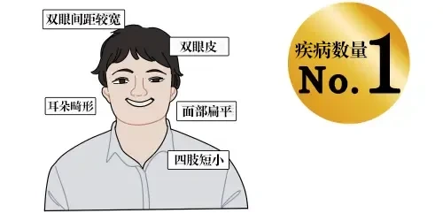 唐氏综合征