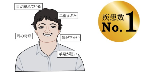 ダウン症(21トリソミー)の説明イラスト