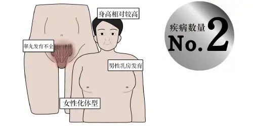 克氏综合征