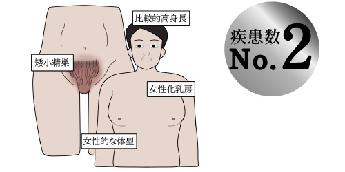 クラインフェルター症候群(47,XXY)の説明イラスト