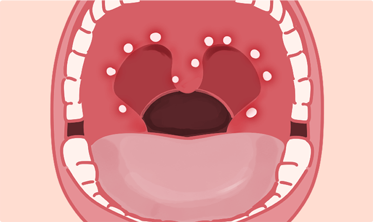 ヘルパンギーナ