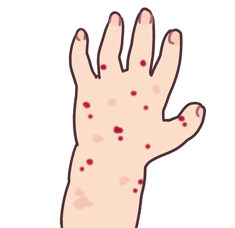 手の発疹